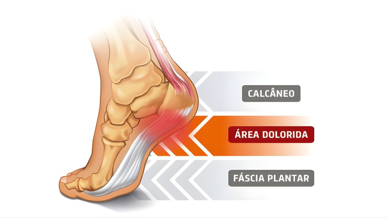 Fascite Plantar