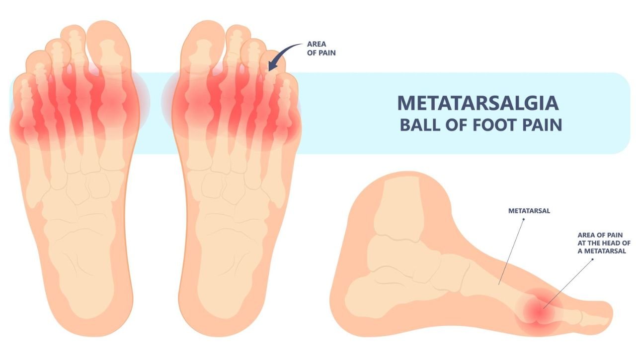 Metatarsalgia